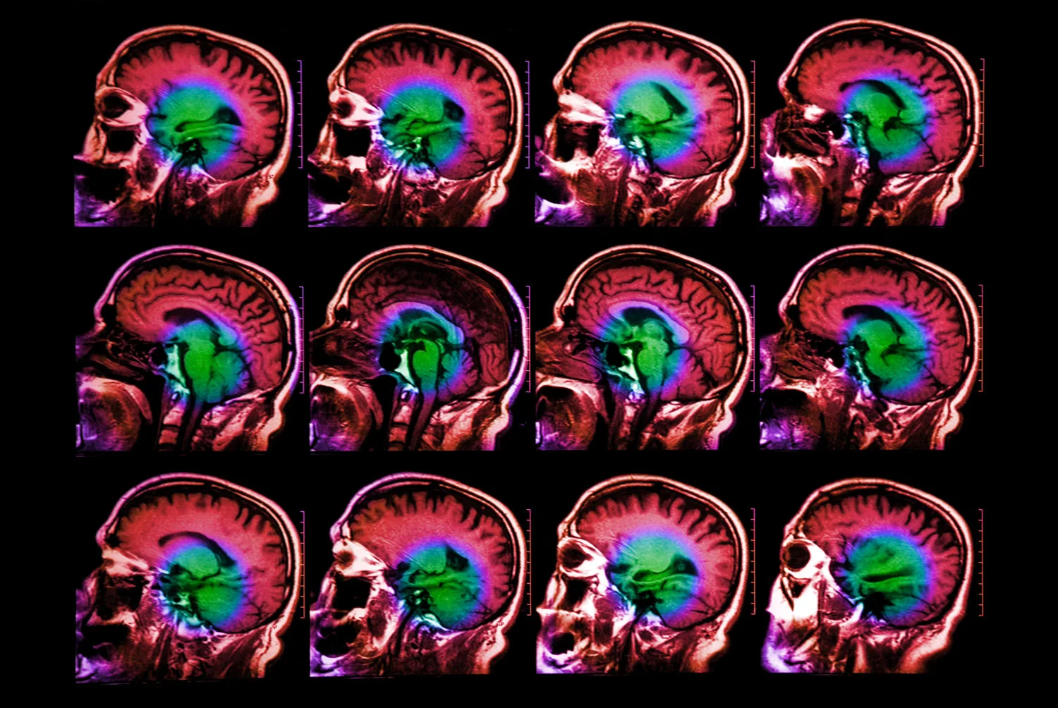 Les scientifiques découvrent des neurones qui traitent le langage à différentes échelles de temps | Actualités du MIT