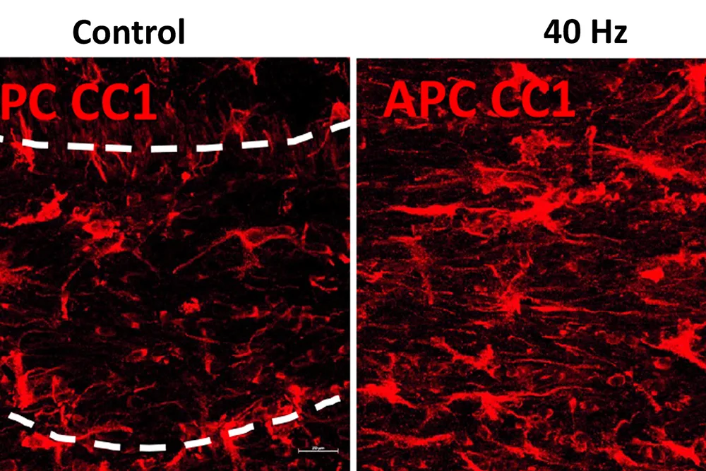 Une étude révèle comment la stimulation sensorielle à 40 Hz peut préserver la « matière blanche » du cerveau | Actualités du MIT